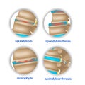 Spine diseases. Various pathologies of intervertebral discs and bones.